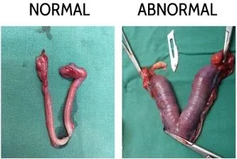 Surgical photo comparing a normal uterus with an enlarged, pus-filled uterus from pyometra