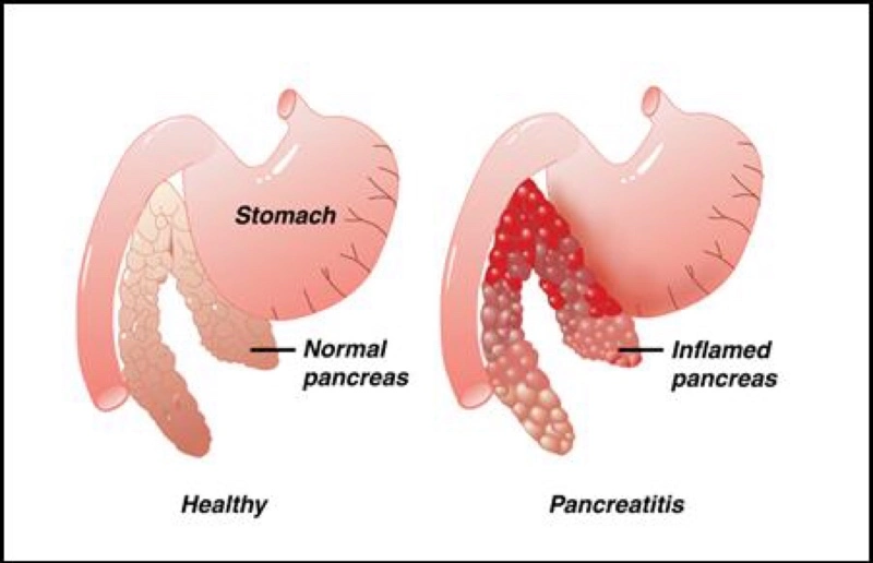 Diagram comparing a healthy pancreas with an inflamed pancreas in canine pancreatitis